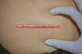 Neat, tidy and clean keloid scar. Straight surgical incision