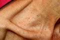 Neck and collarbone in papillomas. Papilloma on the skin. Royalty Free Stock Photo