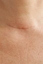 Neck scar after thyroidectomy.Closeup Royalty Free Stock Photo