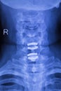 Neck and spine injury xray scan Royalty Free Stock Photo