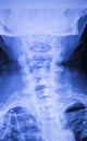 Neck and spine injury xray scan Royalty Free Stock Photo