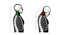 Neck vertebrae deformity