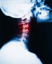 Neck x-ray and pain Royalty Free Stock Photo