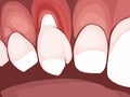 Necrotizing ulcerative gingivitis is a periodontal diseases Royalty Free Stock Photo