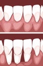 Necrotizing ulcerative gingivitis is a periodontal diseases