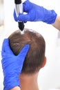 Needle mesotherapy of the scalp.