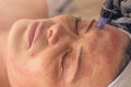 Needle mesotherapy treatment on a woman face.