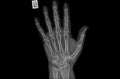 Negative 3D illustration X ray image of human hand Rheumatism