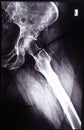 negative x-ray side view of acetabular cavity