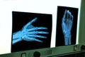 negatoscope with xray of hand Royalty Free Stock Photo