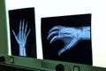 negatoscope with xray of hand Royalty Free Stock Photo