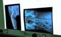 negatoscope with xray of hip and spine Royalty Free Stock Photo