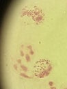 Neisseria gonorrhea - intracellular Gram negative diplococci