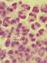 Neisseria gonorrhea - intracellular Gram negative diplococci