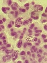 Neisseria gonorrhea - intracellular Gram negative diplococci