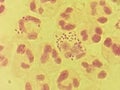 Neisseria gonorrhea - intracellular Gram negative diplococci