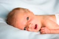Neonatal jaundice - yellowish of the skin in newborn baby