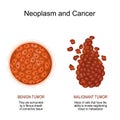 Neoplasm and Cancer. malignant and benign tumor Royalty Free Stock Photo