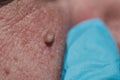 Neoplasm - human papillomavirus on the face of an elderly man, small selective depth of field, defocus, close-up of skin and pores