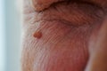 Neoplasm - human papillomavirus on the face of an elderly man, small selective depth of field, defocus, close-up of skin and pores