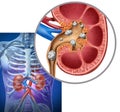Nephrolithiasis or kidney stone deposits