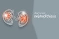 Nephrolithiasis kidney stones disease or urolithiasis. Renal Calculus or Stones blocking the urinary tract.