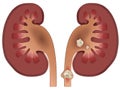 Nephrolithiasis kidney stones disease Royalty Free Stock Photo