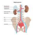 Nephroptosis. Floating kidney or renal ptosis, condition in which the kidney