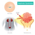 Nephrotic Syndrome. Illustration explain A kidney disorder that causes your body to pass too much protein in your urine