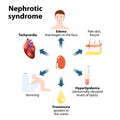 Nephrotic syndrome Royalty Free Stock Photo