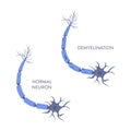 Nerve cell demyelination process medical infographic poster Royalty Free Stock Photo