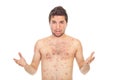 Nervous man with chickenpox Royalty Free Stock Photo