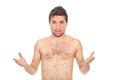 Nervous man with chickenpox