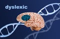 Neural Signature in human brain for Dyslexia, Disruption of Posterior Reading System, dyslexic, dna helix structure,