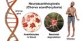 Neuroacanthocytosis, or Chorea acanthocytosis, a neurodegenerative disease, conceptual 3D illustration