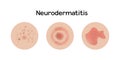 Neurodermatitis examples vector illustration design, allergic problems Royalty Free Stock Photo