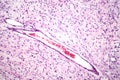 A neurofibroma tissue sample in neurofibromatosis genetic disease, light micrograph