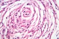 A neurofibroma tissue sample in neurofibromatosis genetic disease, light micrograph