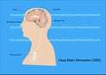 Deep brain stimulation for Parkinson`s disease