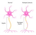 Neuron concept vector. Dendrite, axon, soma of neuron. Multiple sclerosis, nerve anatomy illustration. Royalty Free Stock Photo