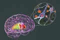 Neuronal inclusions in Huntington's disease, 3D illustration