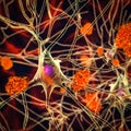 Neurons in Alzheimer's disease. 3D illustration Royalty Free Stock Photo