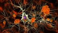 Neurons in Alzheimer's disease Royalty Free Stock Photo