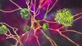 Neurons in Alzheimer's disease Royalty Free Stock Photo