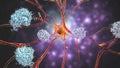 Neurons in Alzheimer's disease. Illustration showing amyloid plaques in brain tissue Royalty Free Stock Photo