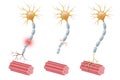 Neuroregeneration refers to the regrowth or repair of nervous tissues, cells or cell products. Peripheral Neuropathy illustration