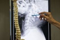 A neurosurgeon pointing at cervical spine x-ray