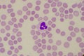 Neutrophil in sepsis patein find with microscope