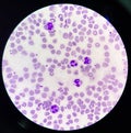 Neutrophil with toxic granulation and vacuole Royalty Free Stock Photo