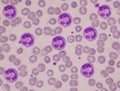 Neutrophil with vacular on red blood cell